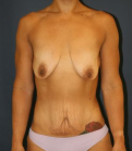Feel Beautiful - Makeover After Weight Loss - Before Photo